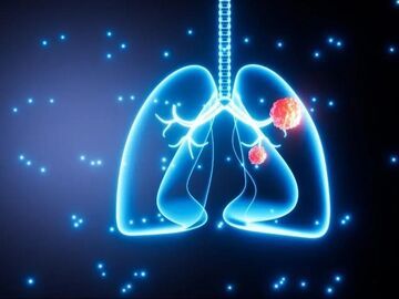 肺癌成中国女性第一大癌症 身体给出“警示”不要忽视