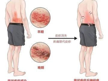 “最疼皮肤病”进入高发期 出现这些疼痛信号别大意