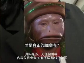新娘婚礼前两天被马蜂蜇伤，嘴唇肿胀“像蛤蟆精”，当事人：连夜就医，婚礼如期举行；医生提醒