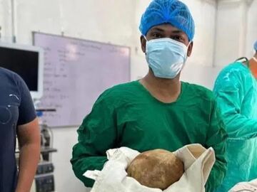 大小如鸵鸟蛋 斯里兰卡一男子体内取出6.2斤巨型膀胱结石