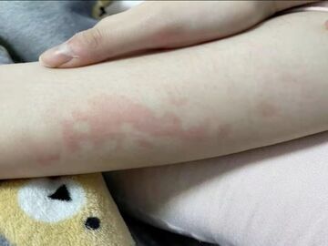 冬季警惕发生低温烫伤!医生提醒:不要通宵使用电热毯